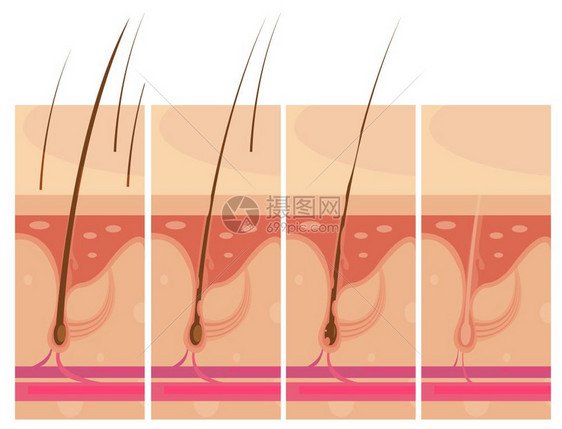 脱发皮肤的脱发故事板作文与轮廓观视图秃头头皮皮肤信息图像矢量插图图片