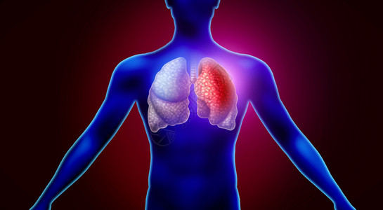 肺感染和呼吸道炎如流感爆发背景图片