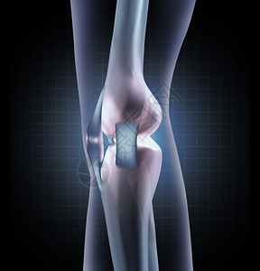 医学概念是人腿关节的侧面带和长颈作为运动医学受伤或诊断的整形象征图片