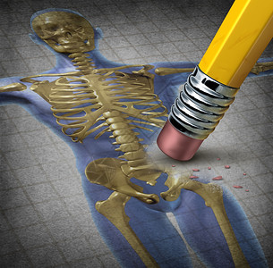 人体骨质疏松症象征骼组织恶化这种疾病有低骨骼质量和脆弱的医学症状用铅笔擦除身体的插图图片