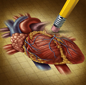 人体心脏健康受损血液循环减少给心血管系统造成问题因为用铅笔擦拭器在纸上抹去一个老旧的外壳医学插图图片