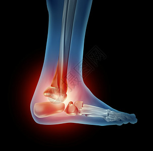 脚踝疼痛有行走身体骨骼部分有红色骨头侧视关节有炎症因鞋子坏或发生事故造成骨折共同受伤图片