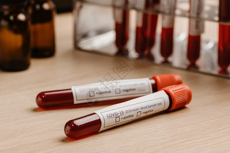 为诊断新的科罗纳感染2019年在实验室中进行验血检查和实验室样本图片