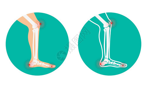腿部疼痛膝盖脚跟矢量说明背景图片