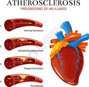 血管硬化血栓解剖图背景图片