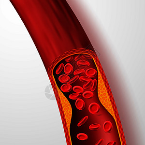 止血管胆固醇清动脉和胆固醇血清3静脉和凝固病媒说明医疗动脉血液胆固醇疾病阻塞流动循环血液容器胆固醇血清动脉和胆固醇血清说明背景图片