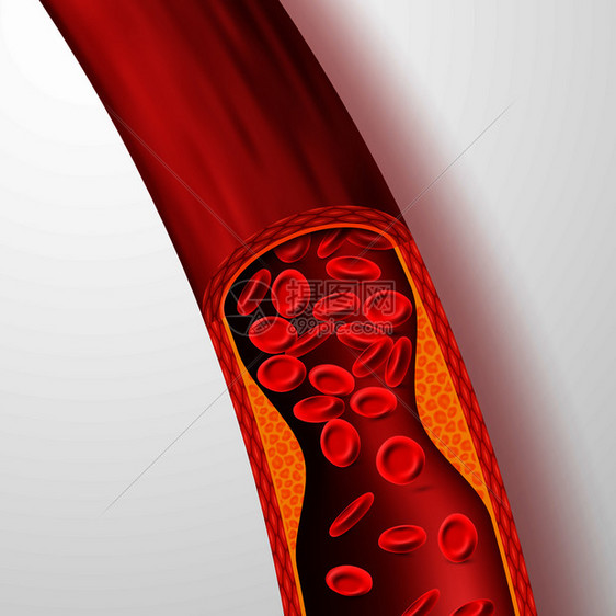 止血管胆固醇清动脉和胆固醇血清3静脉和凝固病媒说明医疗动脉血液胆固醇疾病阻塞流动循环血液容器胆固醇血清动脉和胆固醇血清说明图片
