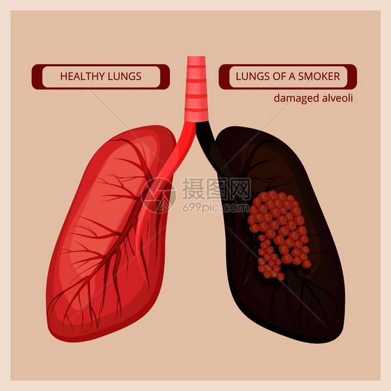肺病图片