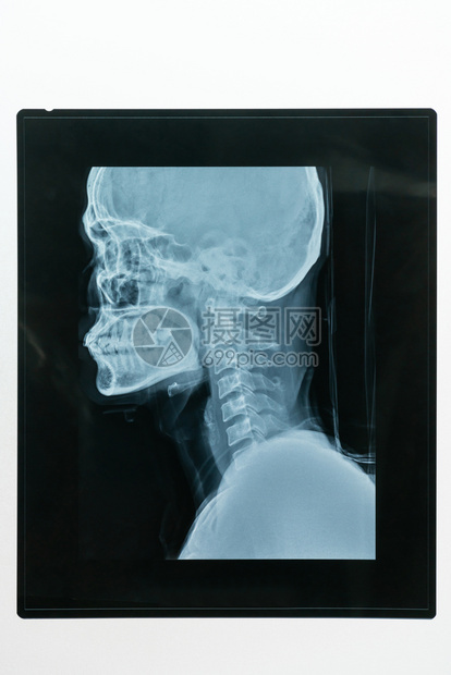 病人头颅和骨的医学x射线图像图片