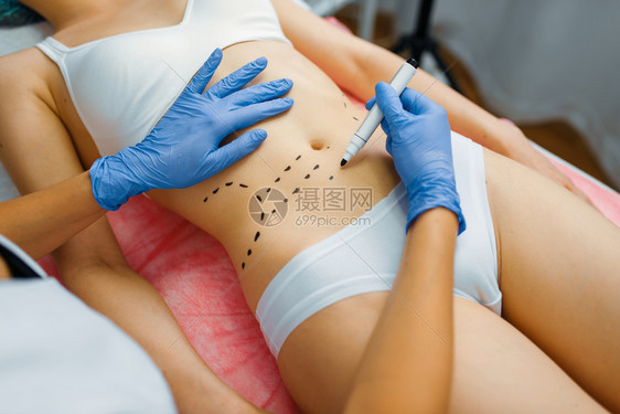 美容师对女患者腹部标记图片
