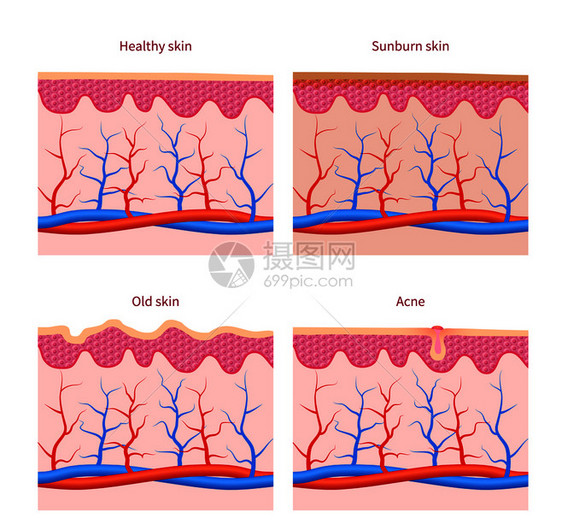 皮肤类型和健康晒伤和老皮肤痤疮向量集人体皮肤层插图皮肤类型健康晒伤和老痤疮向量集图片