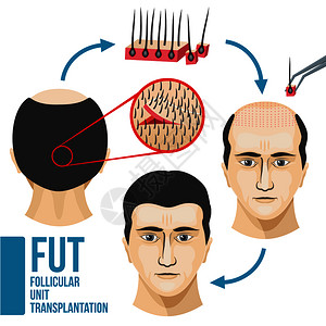 病发和秃头生长移植毛发插图背景图片