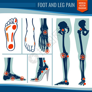 关节炎和风湿整形医学病媒图风湿腿关节脚和疼痛图风湿整形医学病媒图背景图片