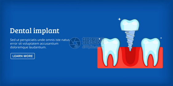 牙科植横向概念科植横向图画网上向矢量牙科植横卡通风格图片