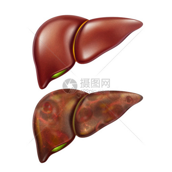肝健康研究和疾病肝硬化癌症胃病肝炎和症图片