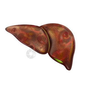 肝脏脂肪疼痛和硬化癌症胃病肝炎症图片