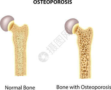 正常骨骼和质疏松高清图片