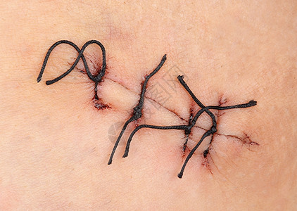 外科缝合的伤口宏图片素材