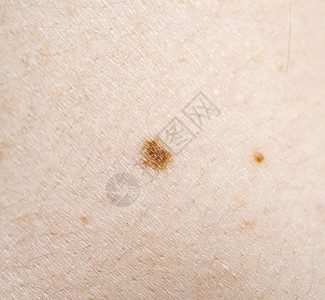 人体皮肤上的黑斑图片素材