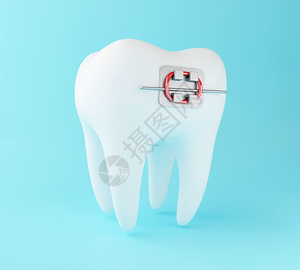 3d说明牙套科护理概念图片