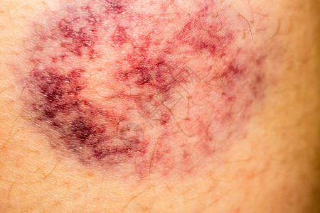 皮肤上的瘀伤图片素材