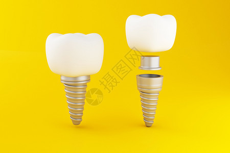 3d说明在黄色背景上植入牙科齿护理概念图片