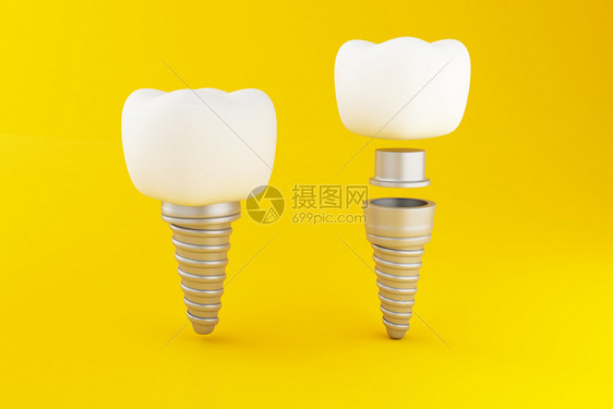 3d说明在黄色背景上植入牙科齿护理概念图片