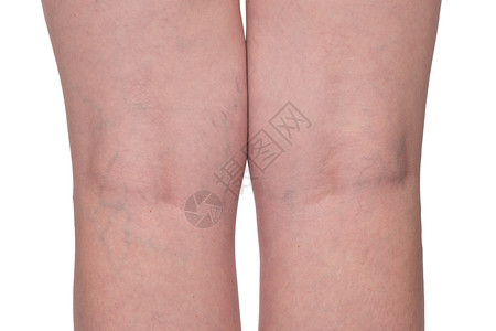 医疗问题血管变动女双腿紧关在白色背景上图片
