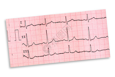 白色背景上孤立的心电图图片