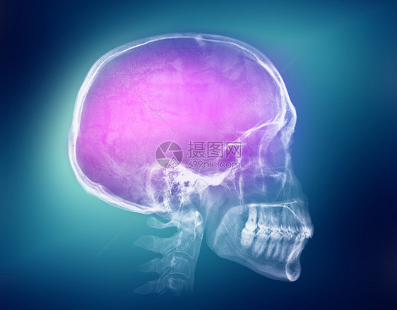 彩色背景上的人类头骨x光图像颅骨x射线图像图片