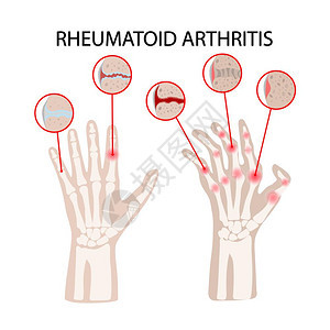 风湿类疾病矢量背景图图片