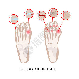 风湿类疾病图片