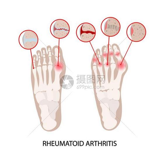 风湿类疾病图片
