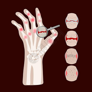 风湿类疾病关节炎 背景图片