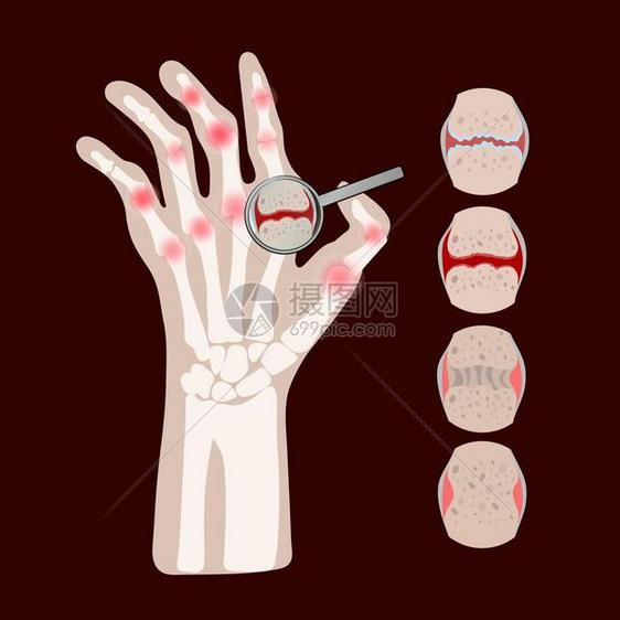 风湿类疾病关节炎 图片