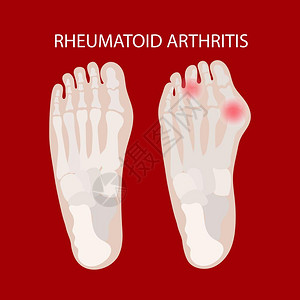 风湿腿关节炎医学教育图图片