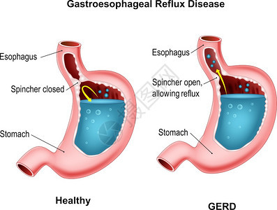 肠胃呼吸回流疾病图片