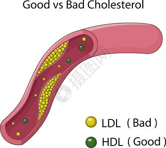 用坏胆固醇堵塞动脉的插图图片