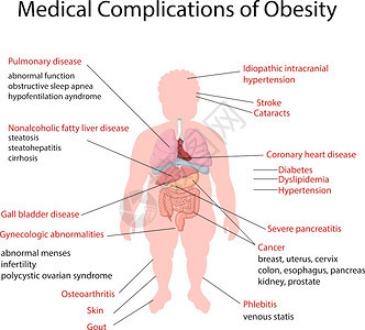 说明肥胖症医学并发背景图片