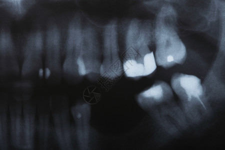 人体牙齿详细X射线图像扫描图片