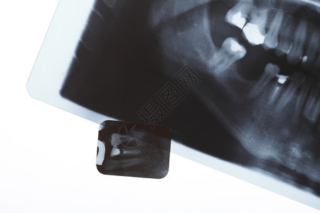 对人类牙齿进行全景和详细的X射线图像扫描图片