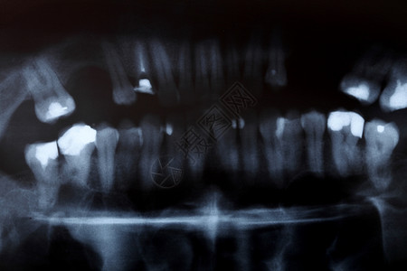 人体牙齿全景X射光图像扫描图片