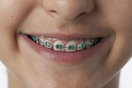 紧的牙套并牙套的套的牙套紧着一个少女的牙齿图片
