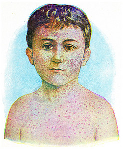 麻疹古老的刻字插图图片
