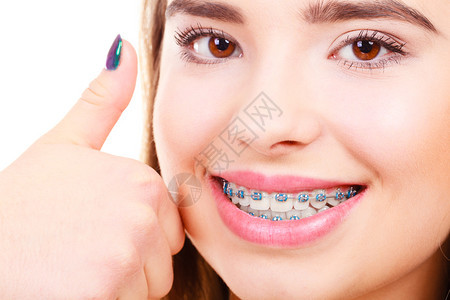妇女微笑用蓝色的牙套拇指举起手势展示她的白牙图片