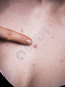 胸口有皮条红斑点的妇女胸口有红斑点的妇女胸口有红斑点的妇女图片
