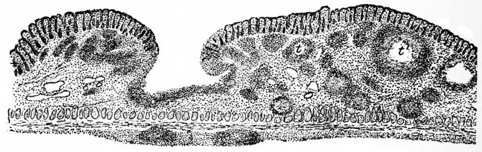 肿瘤溃疡老式刻字插图图片