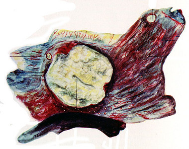 膀胱的肺结核古老刻字插图图片