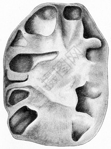 黄热病肾脏长期上升的肺结核刻有古老的图例图片