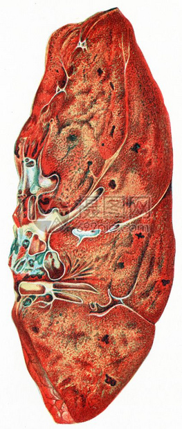 肺部炎古老的雕刻插图图片